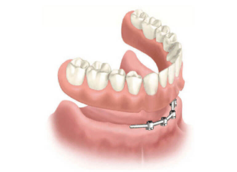 protēzes uz implantiem